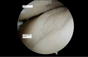 vrste astroscope na koleno z osteoartrozo, 3. stopnja