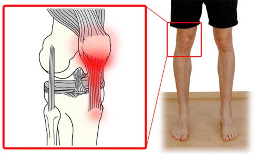 Tendinitis - vnetje kite v kolenskem sklepu