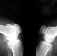 Osteoartroza na x-ray