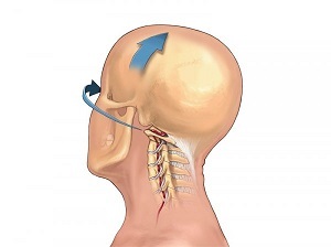 kako se kaže osteohondroza vratne hrbtenice