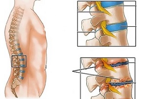 vzroki za osteohondrozo ledvene hrbtenice