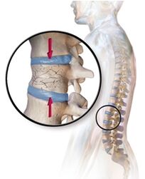 Osteoporoza izzove bolečine v hrbtu v ledvenem delu