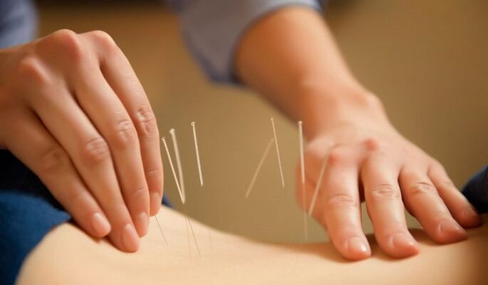 akupunktura za zdravljenje bolečin v križu